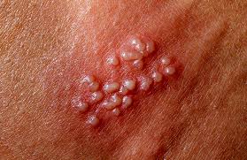 پاورپوینت بیماری مزمن HPV